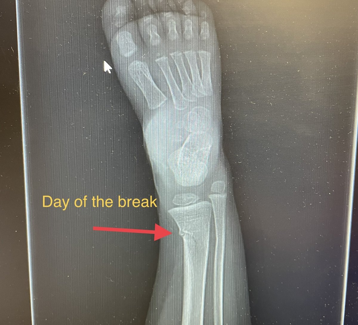 broken bone